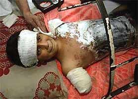 Ali Ismail Abbas received world attention and became 'the poster child' of the Iraq war, but he merely represented hundreds of thousands of Iraqi people either dead or bereaved by the USA-led invasion.